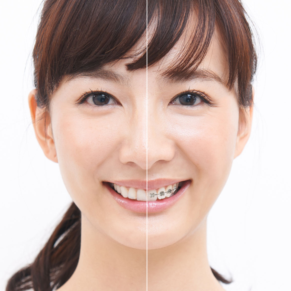 矯正歯科/歯列矯正イメージ